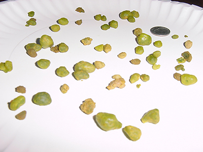 bệnh sỏi gan có nguy hiểm không