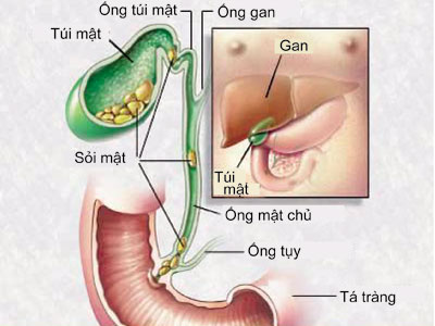 bệnh sỏi mật và cách điều trị
