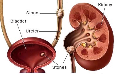cách chữa sỏi thận hiệu quả