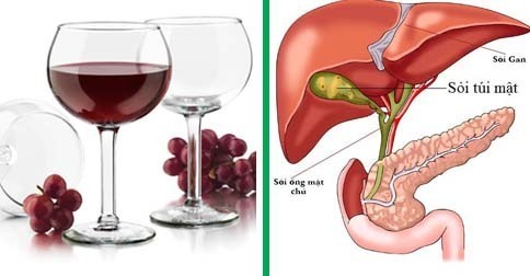Giảm nguy cơ bị sỏi mật bằng rượu vang