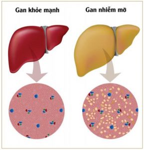 nguyên nhân gan nhiễm mỡ