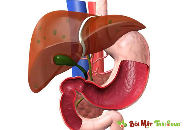 sỏi đường mật trong gan