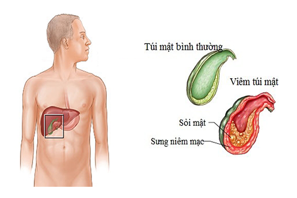 tác hại của bệnh sỏi mật