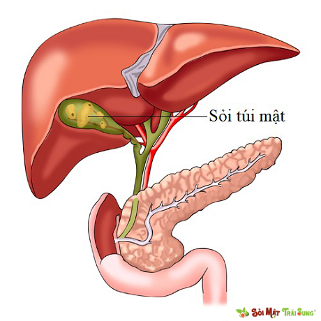 bệnh túi mật, bệnh của túi mật, các bệnh của túi mật