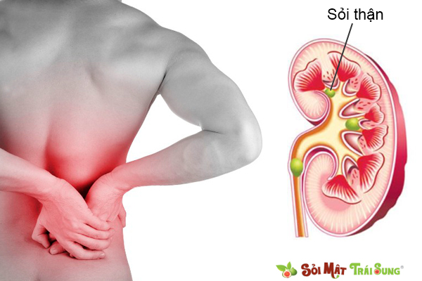 Sỏi thận có ảnh hưởng đến sinh lý và sinh sản không?