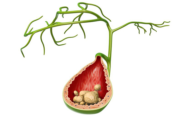 sỏi mật