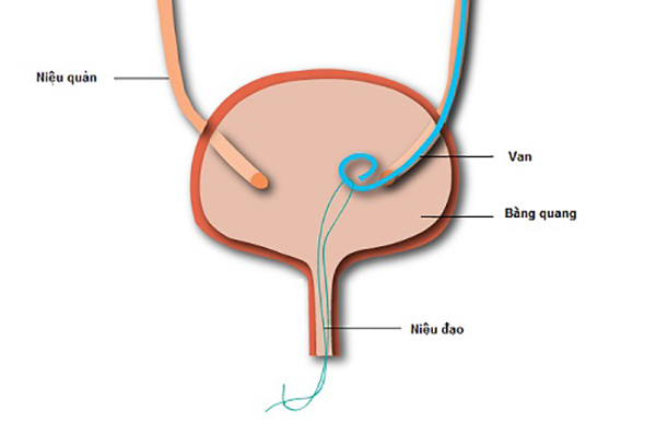 sỏi tiết niệu
