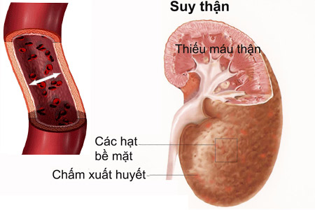 dinh dưỡng suy thận
