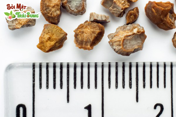 bị sỏi thận có gây đau lưng