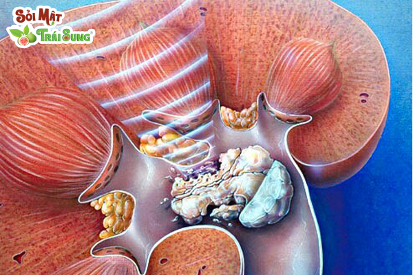 sỏi thận có gây đau lưng không