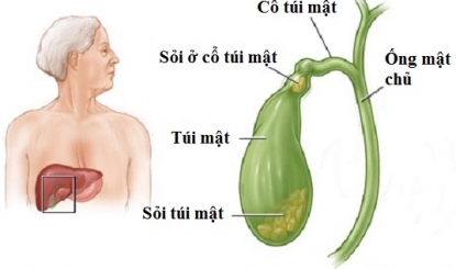 bệnh sỏi mật và cách điều trị
