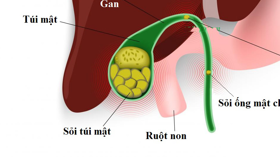 soi bun tui mat la gi