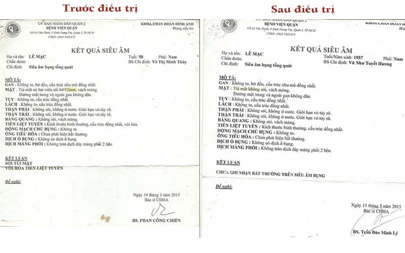 người mắc bệnh sỏi