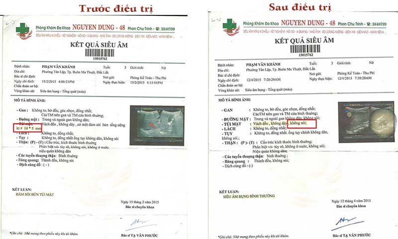 sỏi mật 9mm