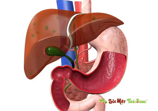 sỏi đường mật trong gan