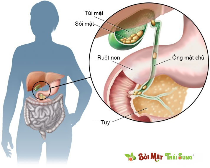 biến chứng của sỏi mật