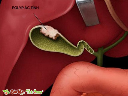 polyp túi mật có nguy hiểm không