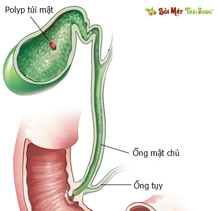 polyp túi mật có nguy hiểm không