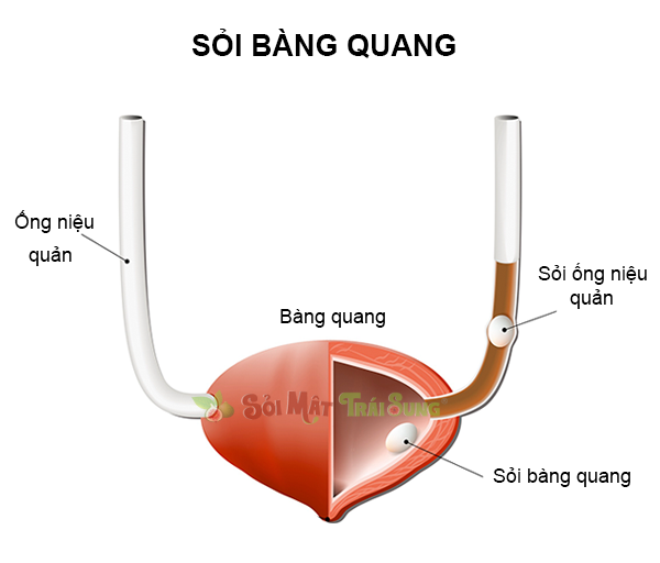 sỏi bàng quang có nguy hiểm