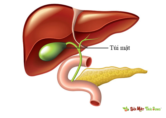 sỏi bùn túi mật