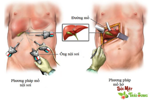 bị sỏi túi mật nên uống thuốc gì