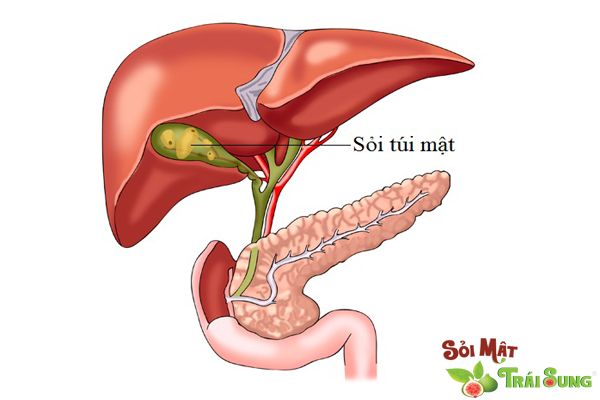 Sỏi túi mật uống thuốc gì