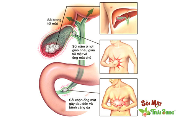 trị sỏi bằng đông y