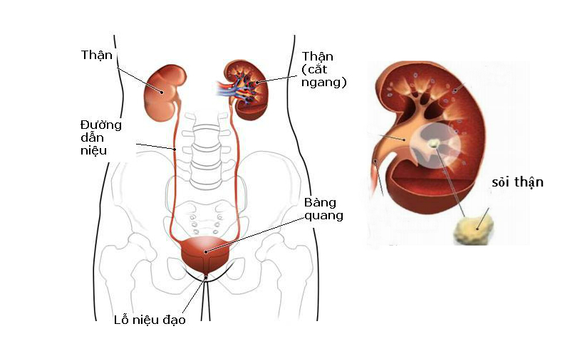 sỏi đường tiết niệu