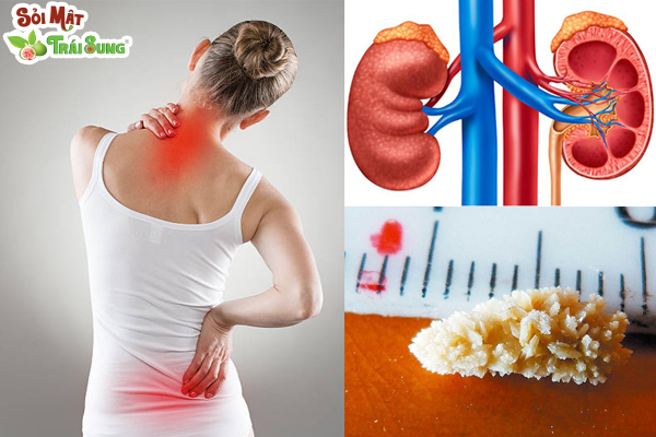 biểu hiện sỏi thận