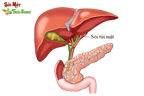 sỏi túi mật có nguy hiểm không