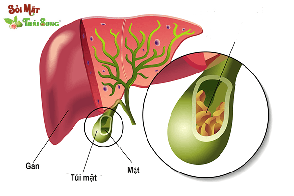 đập tan sỏi mật