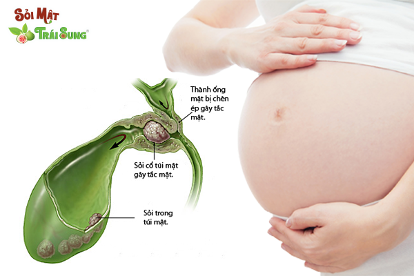 sỏi mật khi mang thai