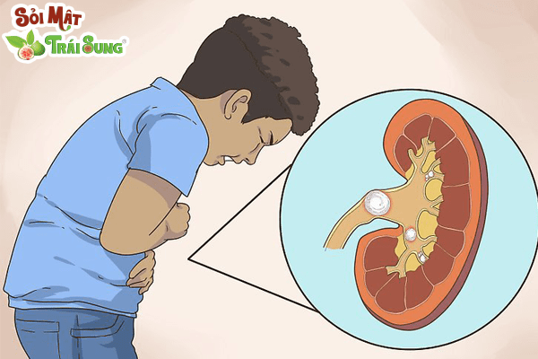 triệu chứng của sỏi thận