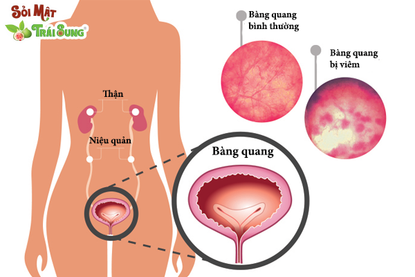 hình ảnh sỏi bàng quang