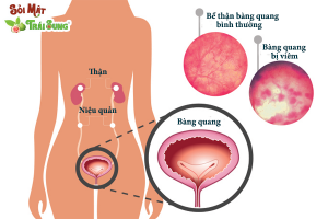 viêm bàng quang có nguy hiểm không