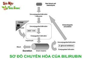 cơ chế hình thành sỏi
