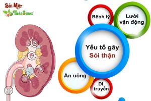 cơ chế hình thành sỏi