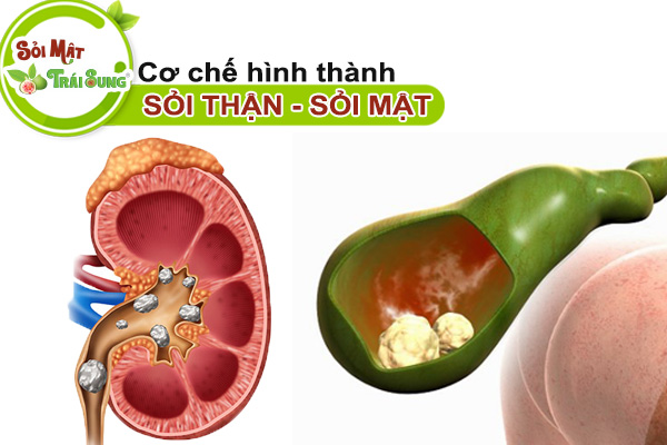 cơ chế hình thành sỏi