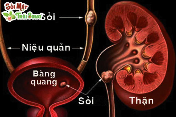 sỏi đường tiết niệu