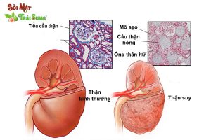 Biến chứng nguy hiểm do suy thận