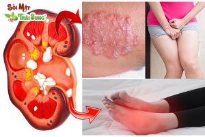Triệu chứng của suy thận