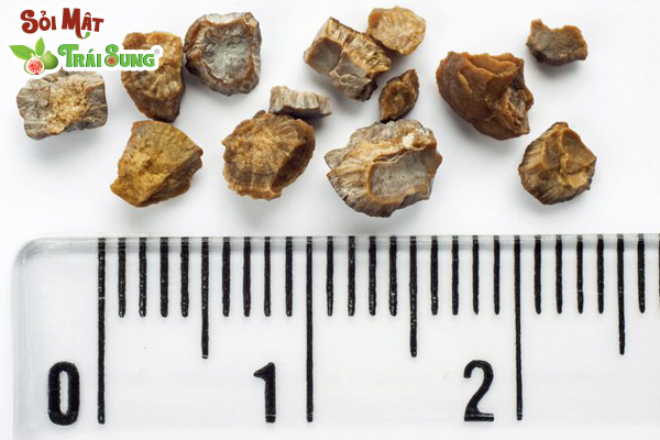 Sỏi thận 6mm