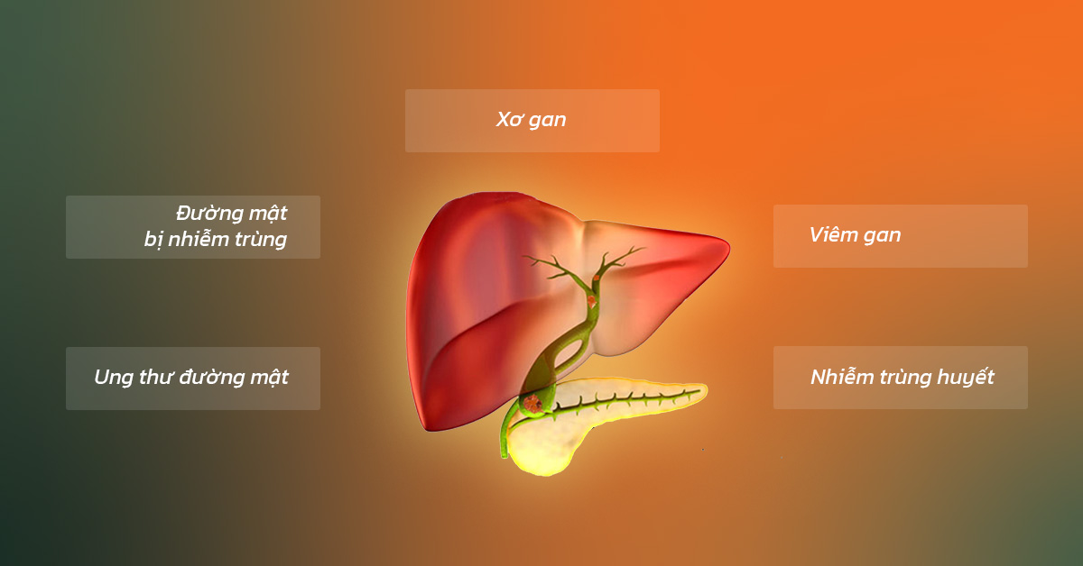 Bệnh sỏi gan gây ra nhiều biến chứng nguy hiểm
