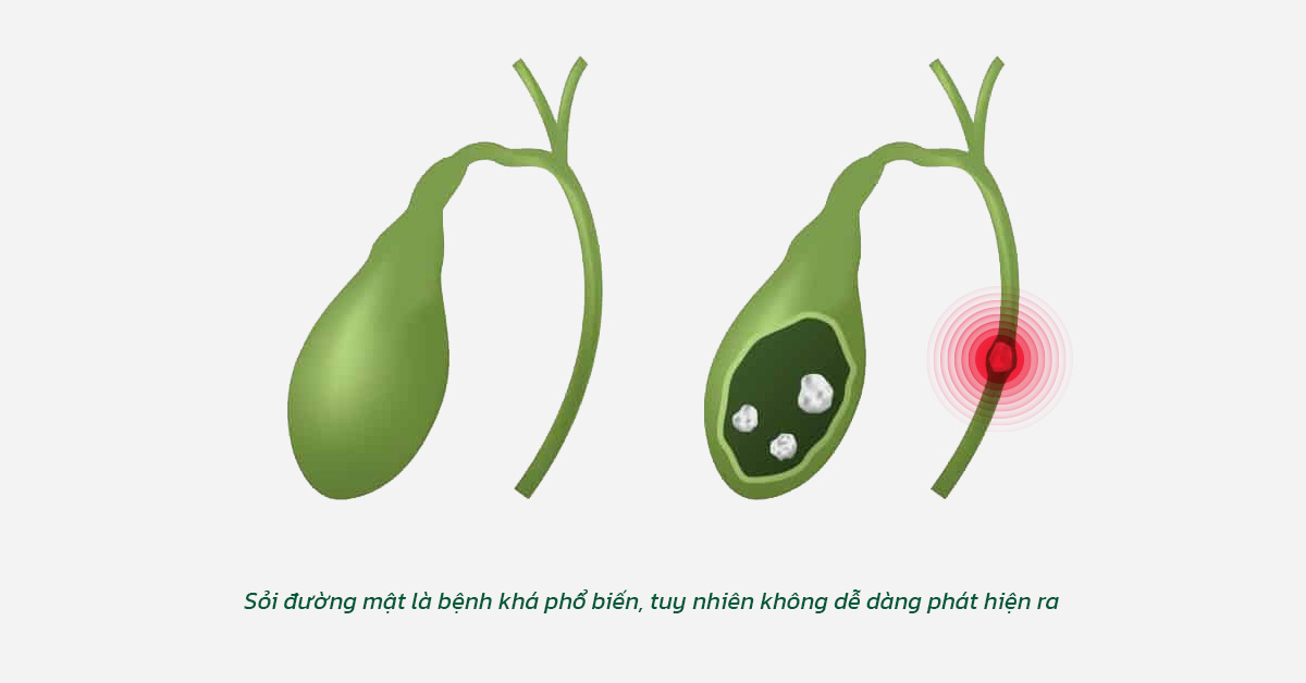 Sỏi đường mật là bệnh khá phổ biến, tuy nhiên không dễ dàng phát hiện ra.