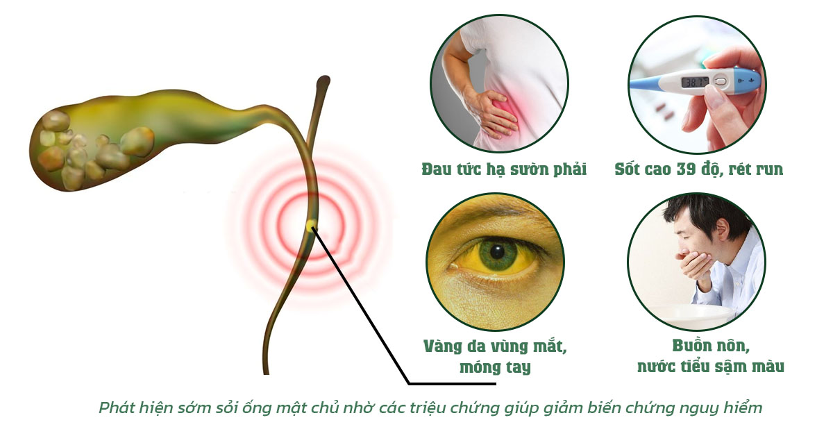 Phát hiện sớm sỏi ống mật chủ nhờ các triệu chứng giúp giảm biến chứng nguy hiểm