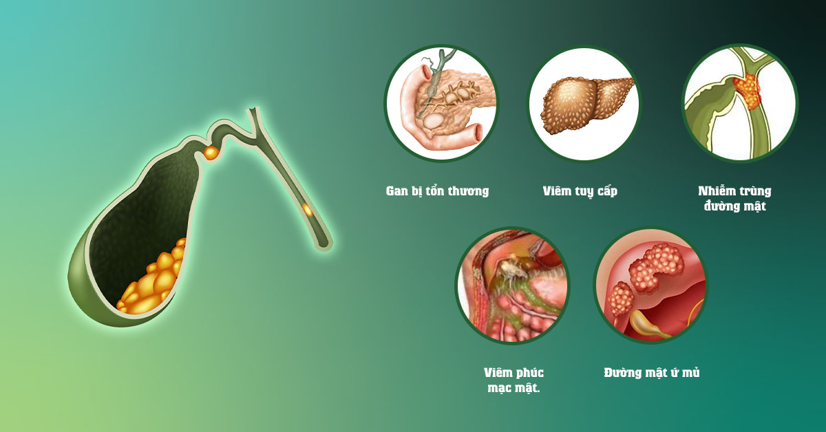 Biến chứng sỏi đường mật gây ra rất nguy hiểm bạn cần chú ý
