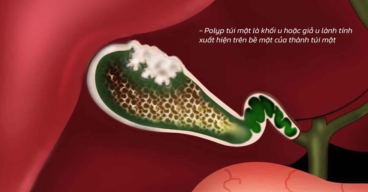 polyptuimat1 Sỏi Mật Trái Sung