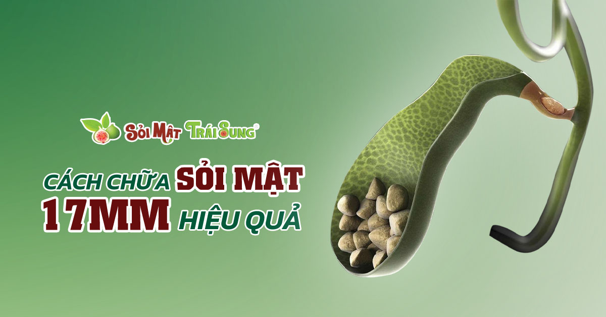 Sỏi túi mật 17mm có nguy hiểm không?