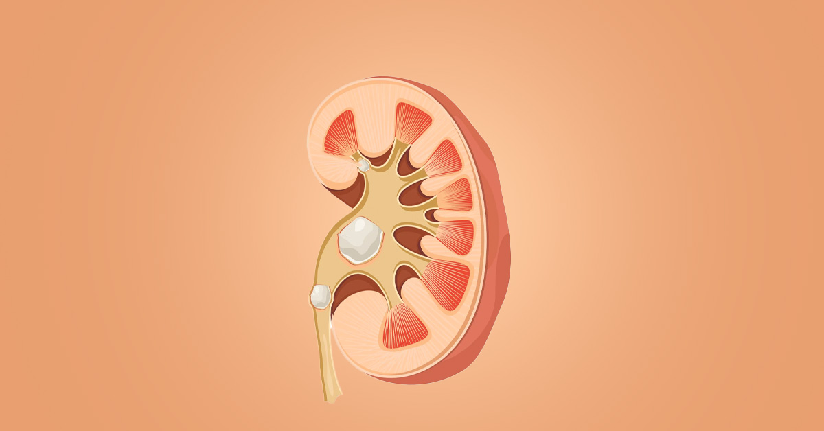 Canxi tồn đọng quá lâu trong thận một thời gian dài không được đào thải sẽ hình thành nên sỏi thận Canxi tồn đọng quá lâu trong thận một thời gian dài không được đào thải sẽ hình thành nên sỏi thận