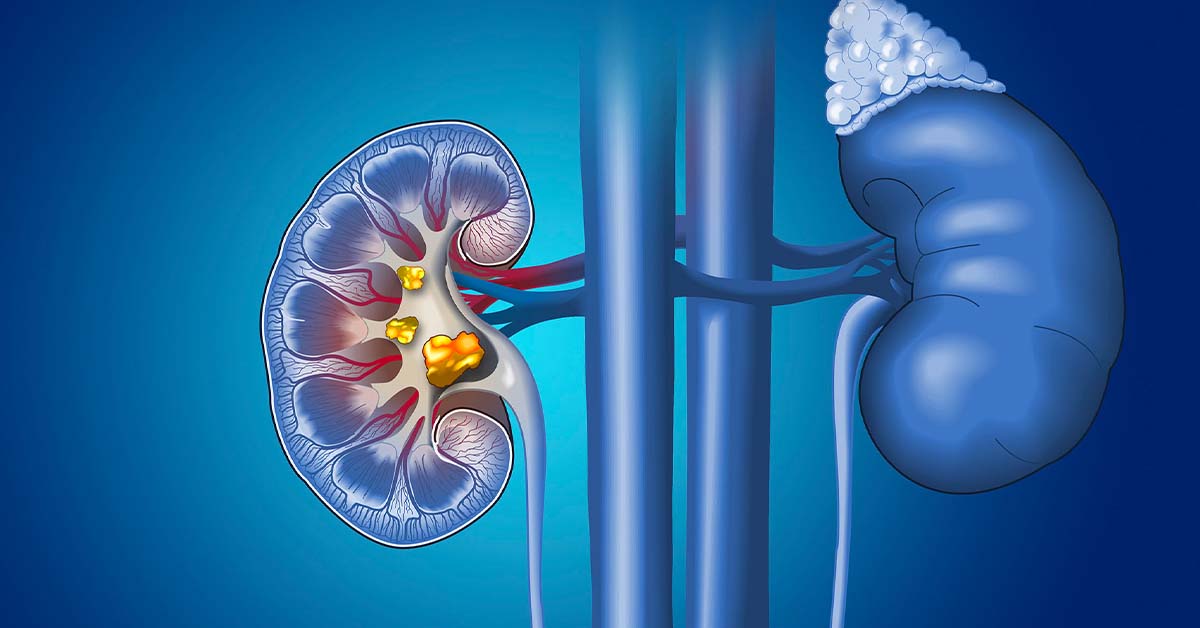  Sỏi thận là nguyên nhân hàng đầu làm cho thận suy yếu 